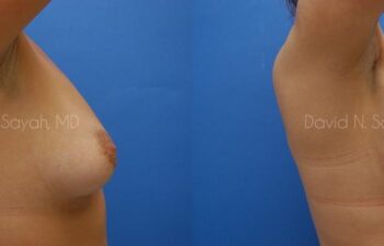 Breast Augmentation Before and After | Sayah Institute