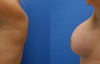 Breast Augmentation Before and After | Sayah Institute