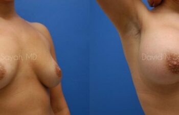 Breast Augmentation Before and After | Sayah Institute