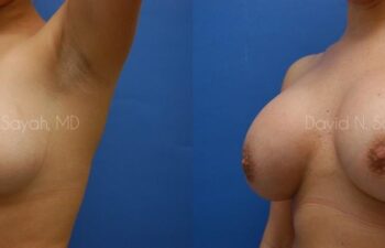 Breast Augmentation Before and After | Sayah Institute