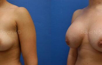Breast Augmentation Before and After | Sayah Institute