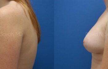 Breast Augmentation Before and After | Sayah Institute