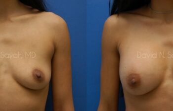 Breast Augmentation Before and After | Sayah Institute
