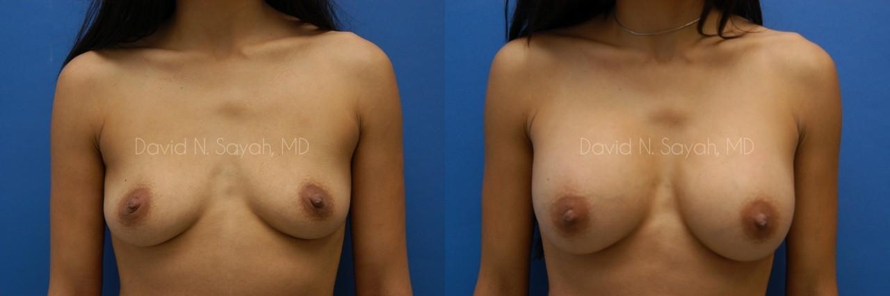Breast Augmentation Before and After | Sayah Institute