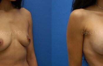 Breast Augmentation Before and After | Sayah Institute