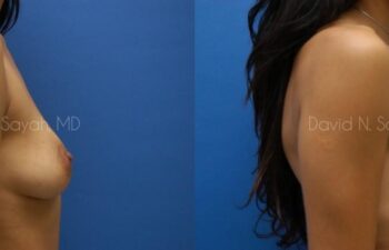Breast Augmentation Before and After | Sayah Institute