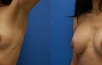 Breast Augmentation Before and After | Sayah Institute