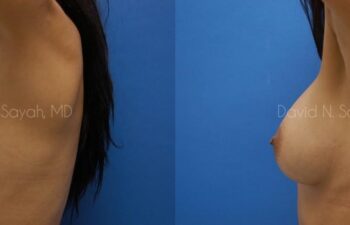 Breast Augmentation Before and After | Sayah Institute
