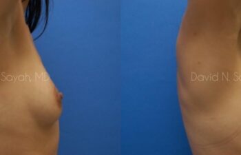 Breast Augmentation Before and After | Sayah Institute