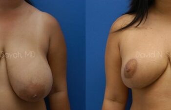 Breast Reduction Before and After | Sayah Institute