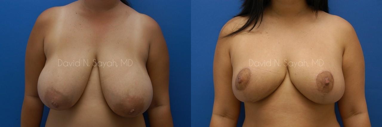 Breast Reduction Before and After | Sayah Institute