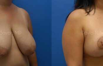 Breast Reduction Before and After | Sayah Institute