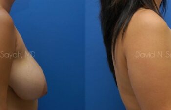 Breast Reduction Before and After | Sayah Institute