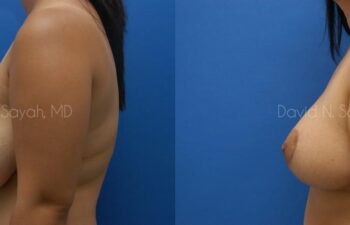 Breast Reduction Before and After | Sayah Institute