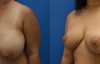 Breast Reduction Before and After | Sayah Institute