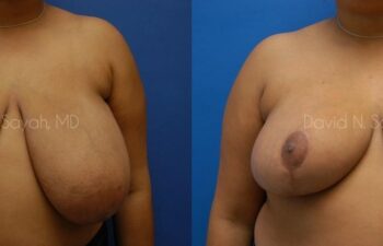 Breast Reduction Before and After | Sayah Institute