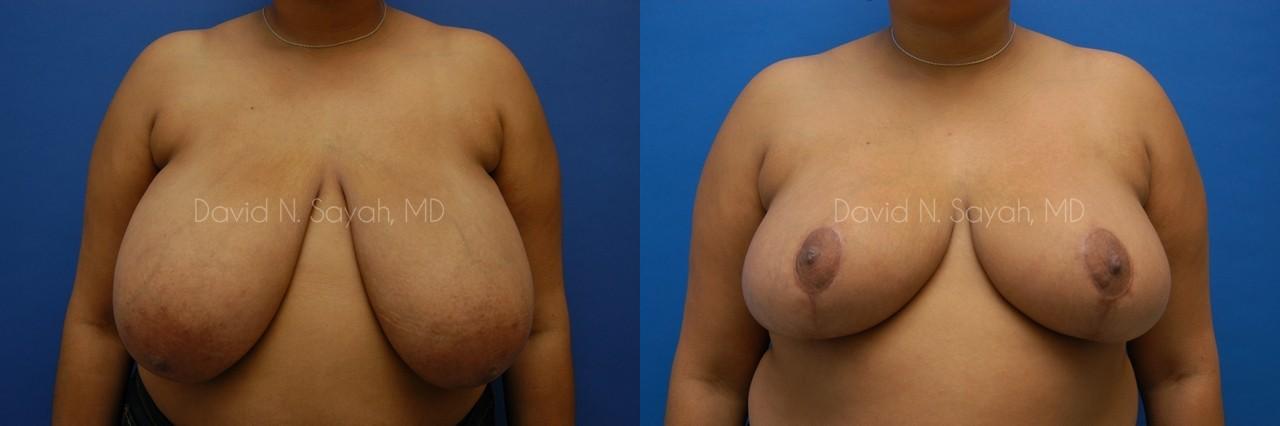 Breast Reduction Before and After | Sayah Institute