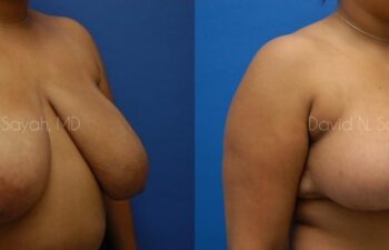 Breast Reduction Before and After | Sayah Institute
