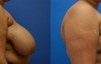 Breast Reduction Before and After | Sayah Institute