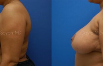 Breast Reduction Before and After | Sayah Institute