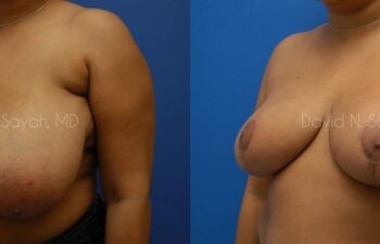 Breast Reduction Before and After | Sayah Institute