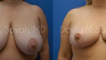 Breast Reduction Before and After | Sayah Institute