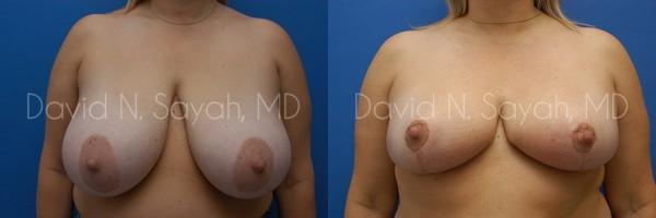 Breast Reduction Before and After | Sayah Institute