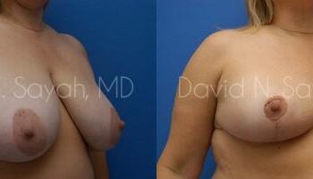 Breast Reduction Before and After | Sayah Institute
