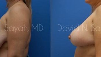 Breast Reduction Before and After | Sayah Institute