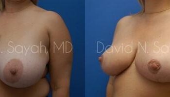 Breast Reduction Before and After | Sayah Institute