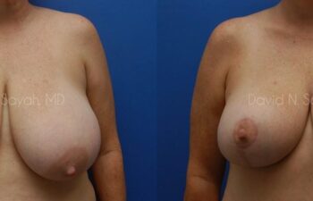 Breast Reduction Before and After | Sayah Institute