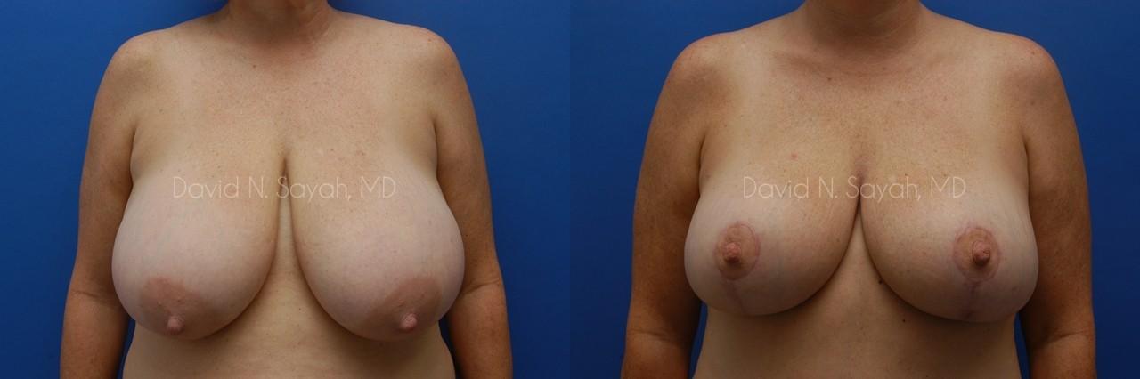 Breast Reduction Before and After | Sayah Institute