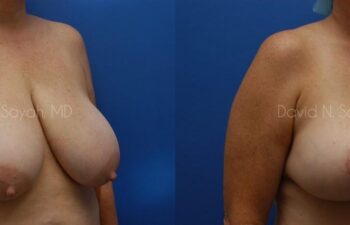 Breast Reduction Before and After | Sayah Institute