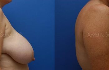 Breast Reduction Before and After | Sayah Institute