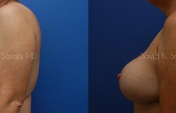 Breast Reduction Before and After | Sayah Institute