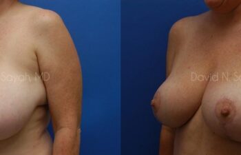 Breast Reduction Before and After | Sayah Institute