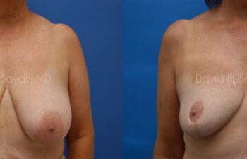 Breast Reduction Before and After | Sayah Institute