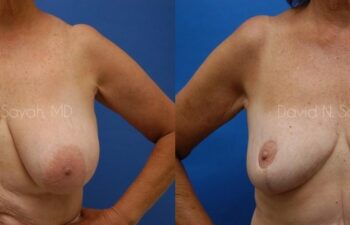 Breast Reduction Before and After | Sayah Institute