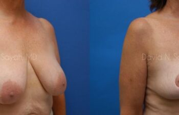 Breast Reduction Before and After | Sayah Institute