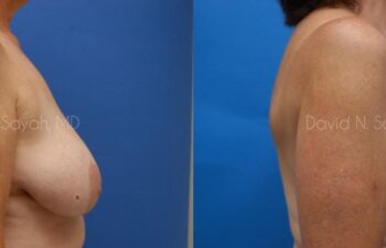 Breast Reduction Before and After | Sayah Institute