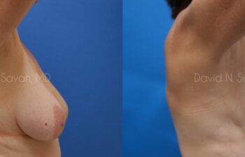 Breast Reduction Before and After | Sayah Institute