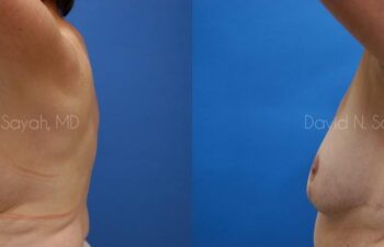 Breast Reduction Before and After | Sayah Institute