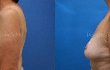 Breast Reduction Before and After | Sayah Institute