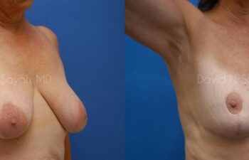 Breast Reduction Before and After | Sayah Institute
