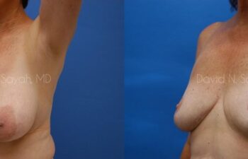 Breast Reduction Before and After | Sayah Institute