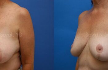 Breast Reduction Before and After | Sayah Institute