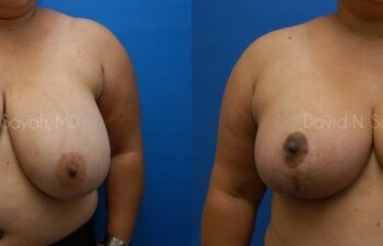 Breast Reduction Before and After | Sayah Institute