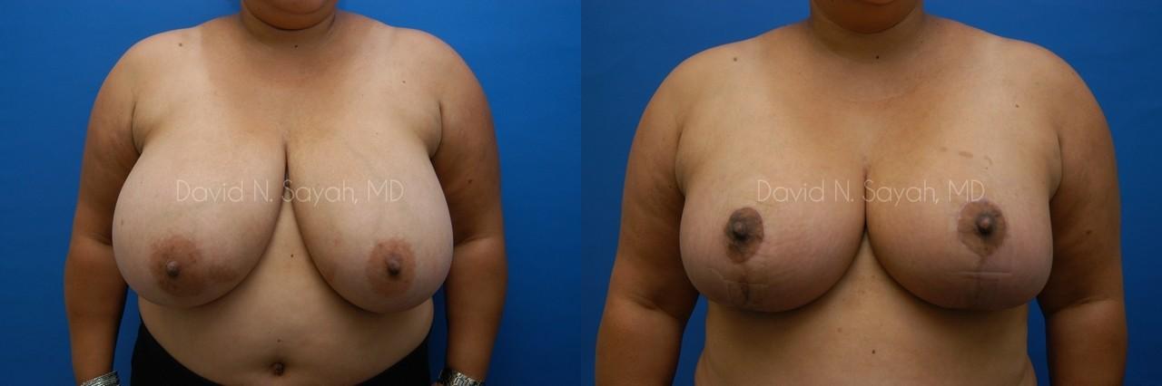Breast Reduction Before and After | Sayah Institute