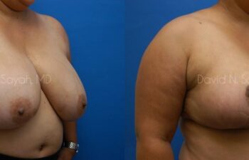 Breast Reduction Before and After | Sayah Institute