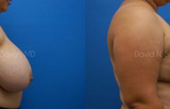 Breast Reduction Before and After | Sayah Institute